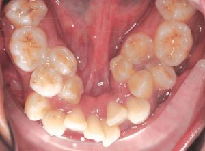mandibular arch showing hyperdontia or supernumerary teeth